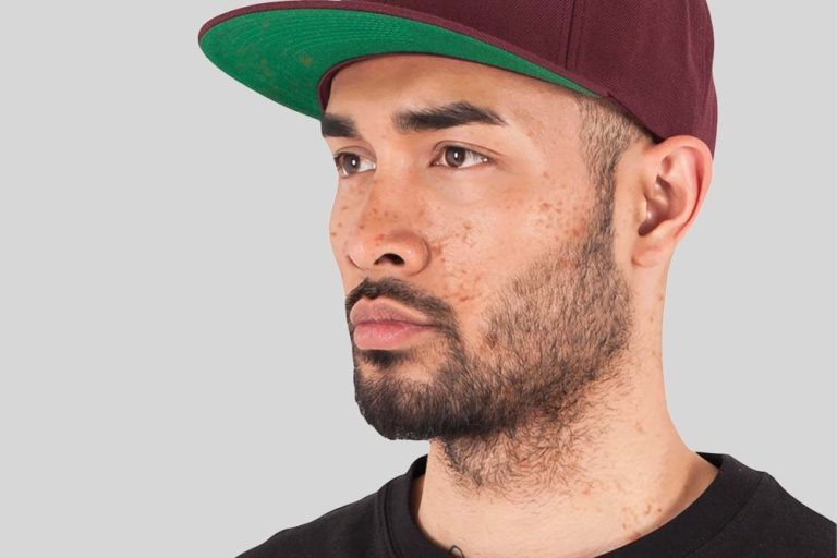 Before Headshot Retouching: Man wearing maroon hat with green trim, showcasing some pimples on his face